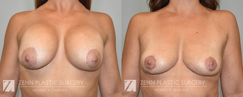 Breast Implant Removal Before & After Gallery - Patient 130812 - Image 1