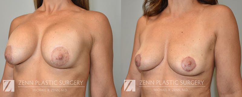 Breast Implant Removal Before & After Gallery - Patient 130812 - Image 2