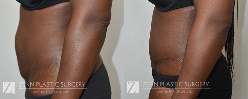 Tummy Tuck Before & After Gallery - Patient 402327 - Image 2