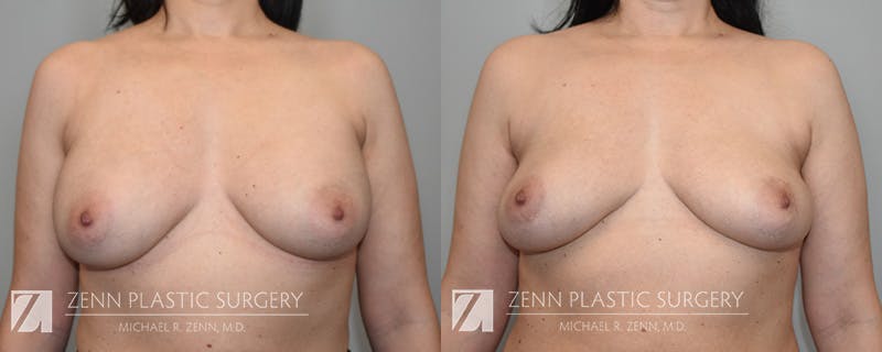 Mommy Makeover Before & After Gallery - Patient 106400618 - Image 3