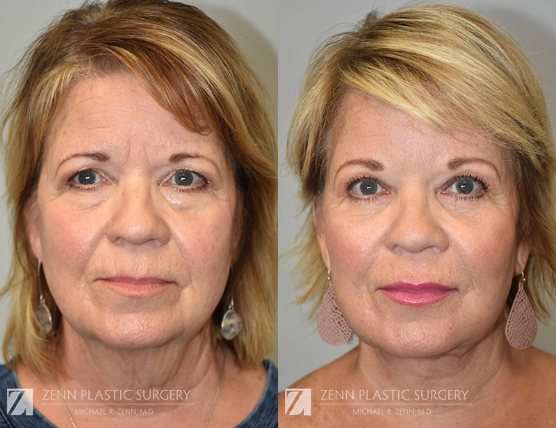 Patient 915121 | Facelift Before & After Photos | Zenn Plastic Surgery