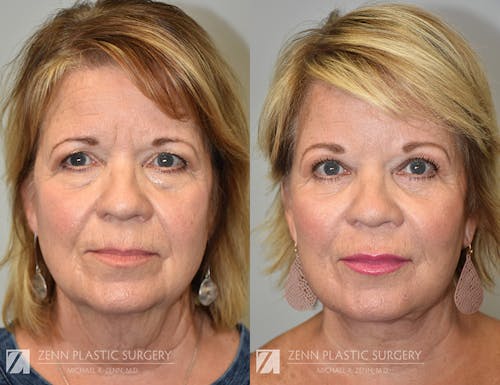 Gallery Before Image