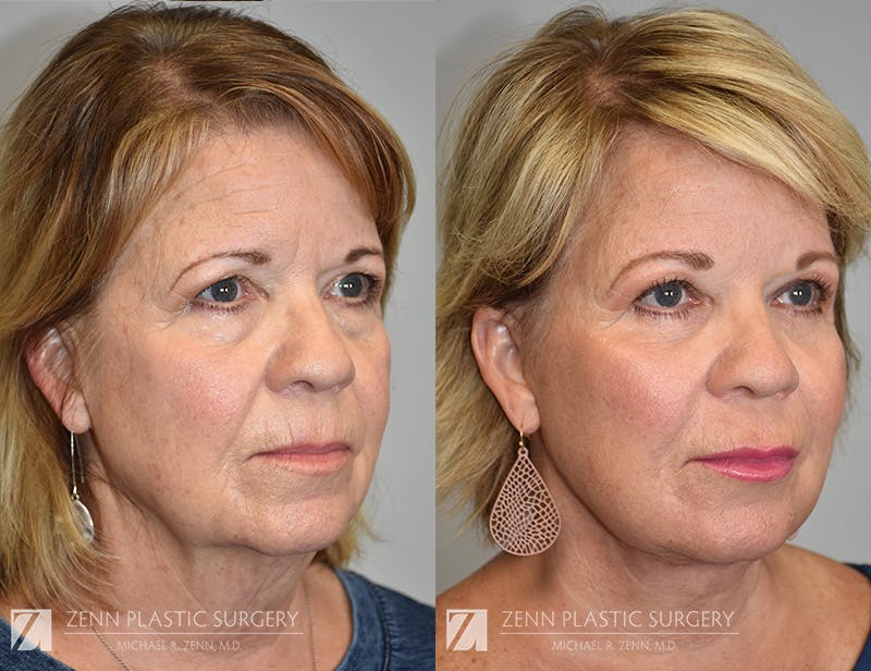 Facelift Before & After Gallery - Patient 915121 - Image 2
