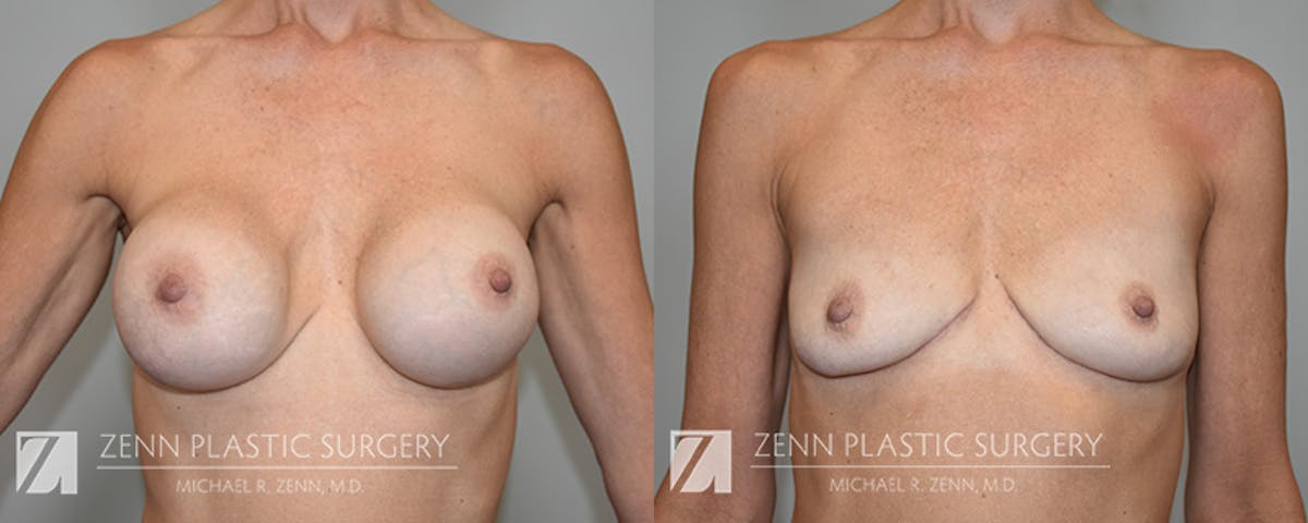 Breast Implant Removal Before & After Gallery - Patient 287814 - Image 1