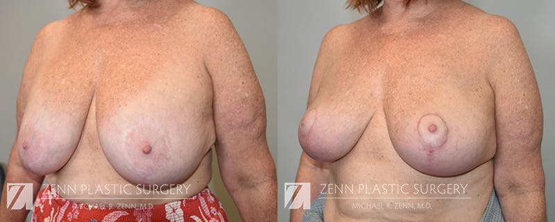 Breast Implant Removal Before & After Gallery - Patient 394458 - Image 2