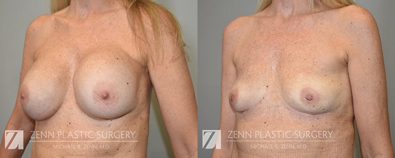 Breast Implant Removal Before & After Gallery - Patient 380682 - Image 2