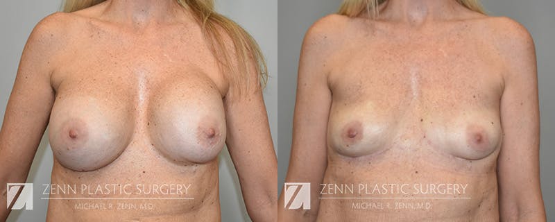 Breast Implant Removal Before & After Gallery - Patient 380682 - Image 1