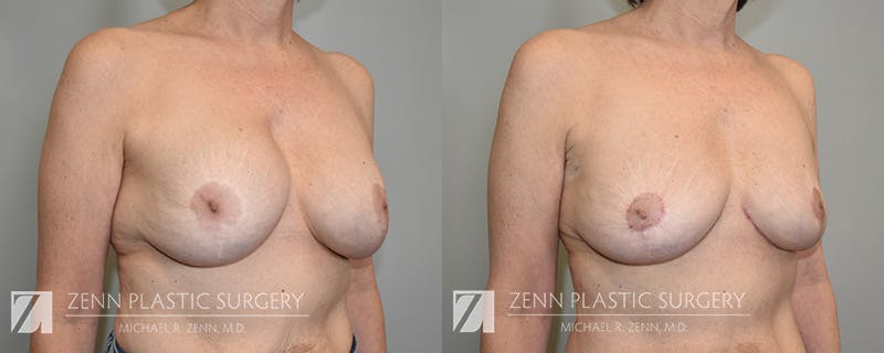 Breast Implant Removal Before & After Gallery - Patient 903903 - Image 2