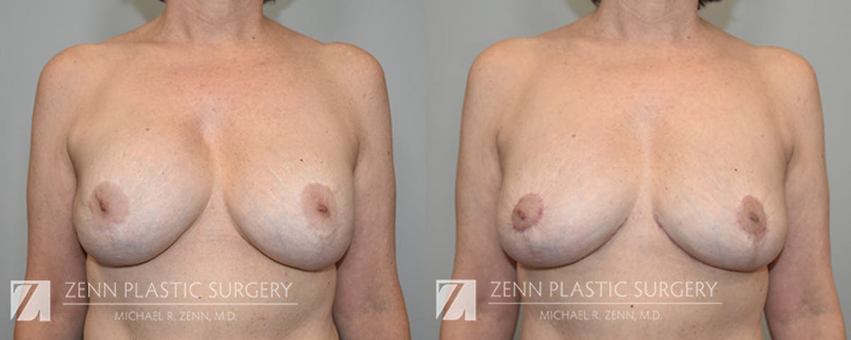 Breast Implant Removal Before & After Gallery - Patient 903903 - Image 1