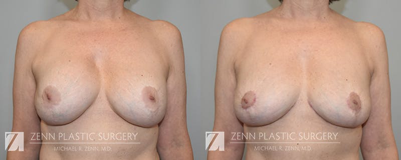 Breast Implant Removal Before & After Gallery - Patient 903903 - Image 1