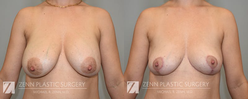 Breast Implant Removal Before & After Gallery - Patient 194047 - Image 1