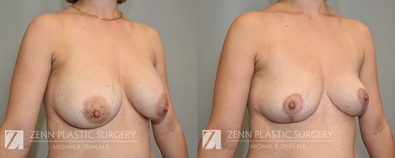 Breast Implant Removal Before & After Gallery - Patient 194047 - Image 2