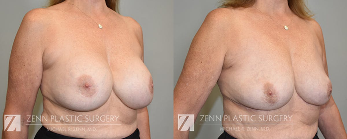 Breast Implant Removal Before & After Gallery - Patient 374182 - Image 2