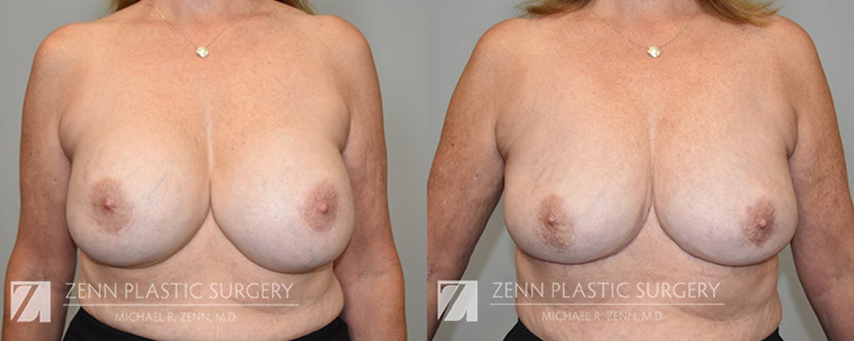 Breast Implant Removal Before & After Gallery - Patient 374182 - Image 1