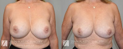 Breast Implant Removal Before & After Gallery - Patient 374182 - Image 1