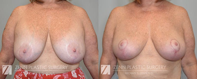 Breast Implant Removal Before & After Gallery - Patient 394458 - Image 1