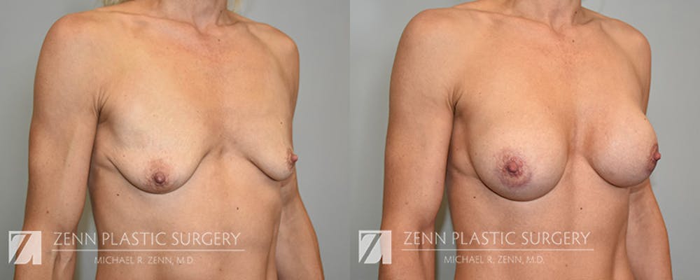 Breast Augmentation Before & After Gallery - Patient 170916 - Image 2
