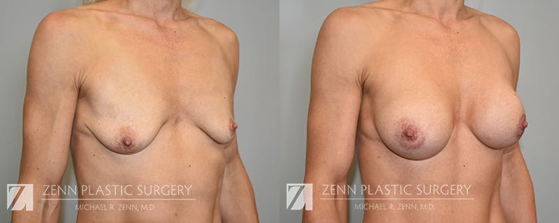 Breast Augmentation Before & After Gallery - Patient 170916 - Image 2