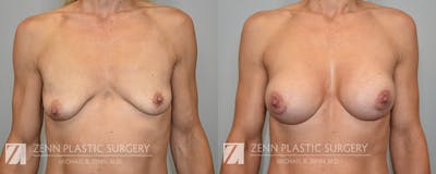 Breast Augmentation Before & After Gallery - Patient 170916 - Image 1