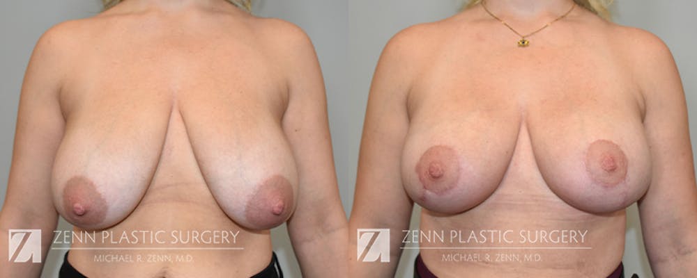 Breast Lift + Implants Before & After Gallery - Patient 222737 - Image 1