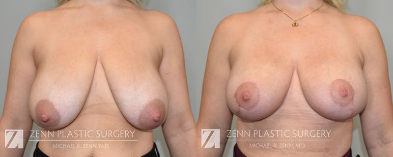 Breast Lift + Implants Before & After Gallery - Patient 222737 - Image 1