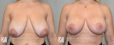 Breast Lift + Implants Before & After Gallery - Patient 222737 - Image 1