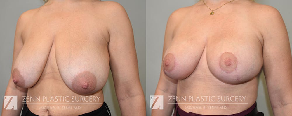 Breast Lift + Implants Before & After Gallery - Patient 222737 - Image 2