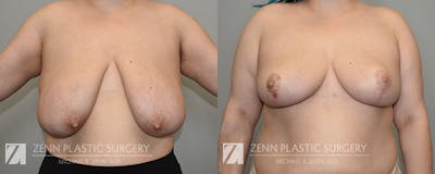 Breast Reduction Before & After Gallery - Patient 244282 - Image 1