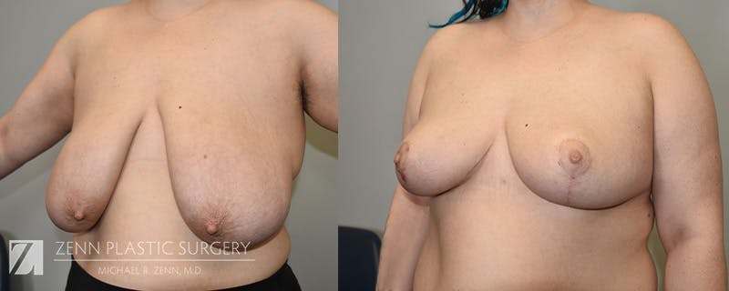 Breast Reduction Before & After Gallery - Patient 244282 - Image 2