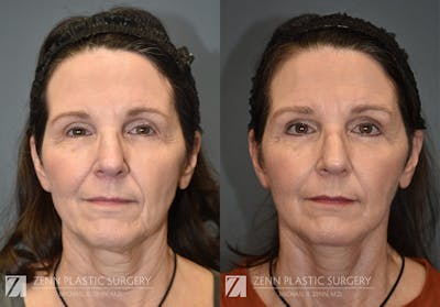 Facelift Before & After Gallery - Patient 106400560 - Image 1