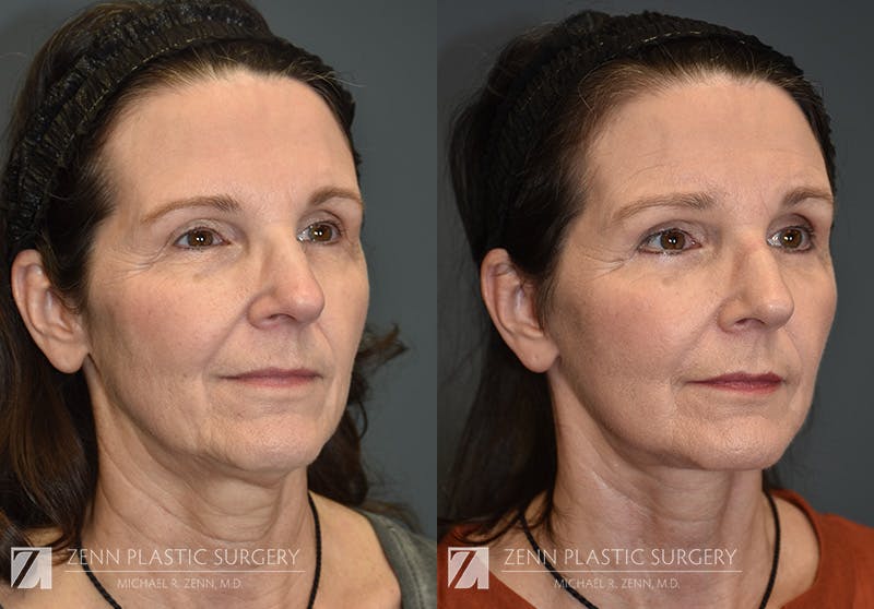 Facelift Before & After Gallery - Patient 106400560 - Image 2