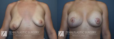 Breast Lift + Implants Before & After Gallery - Patient 368552 - Image 1