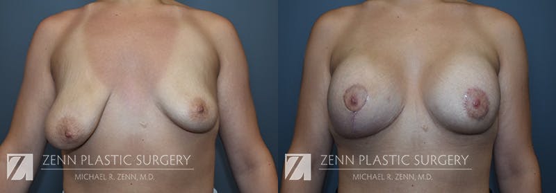 Breast Lift + Implants Before & After Gallery - Patient 368552 - Image 1