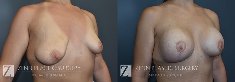 Breast Lift + Implants Before & After Gallery - Patient 368552 - Image 2