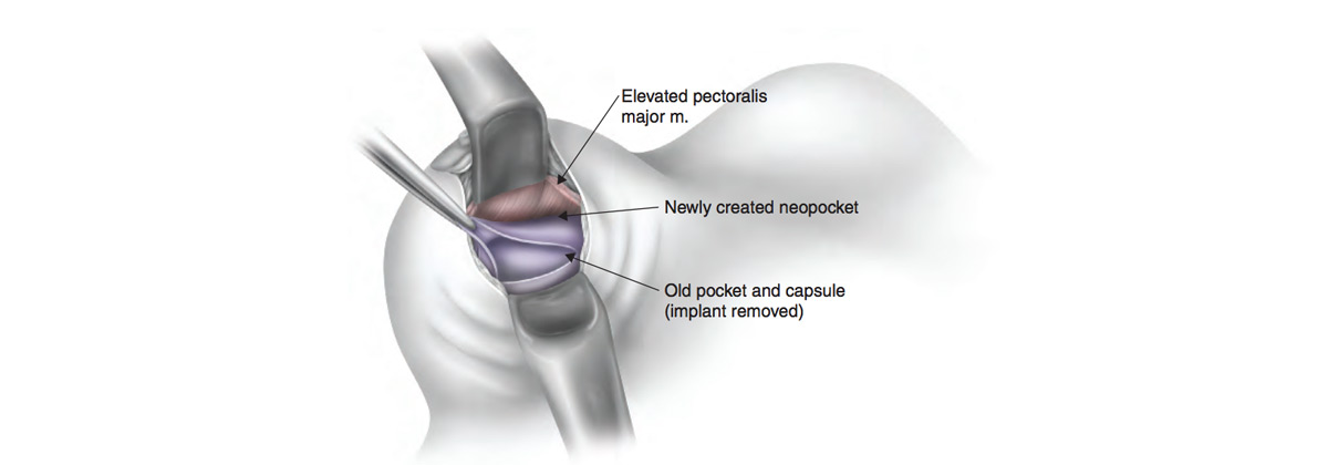 Implant diagram