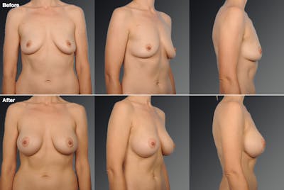 Breast Augmentation before & after