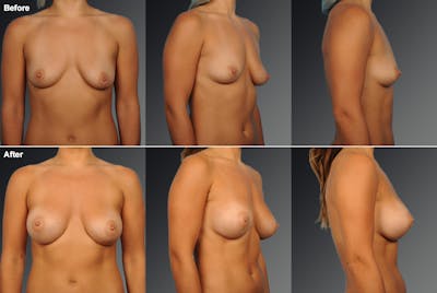 Breast Augmentation before & after