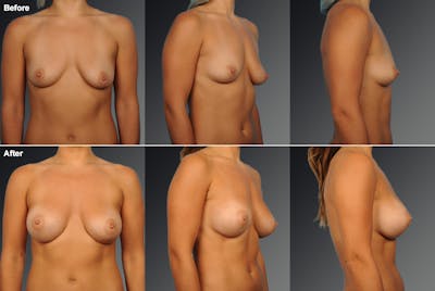 Breast Augmentation Before & After Gallery - Patient 104098350 - Image 1
