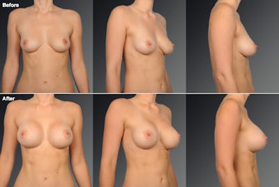 Breast Augmentation before & after