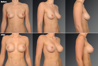 Breast Augmentation Before & After Gallery - Patient 104098353 - Image 1