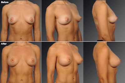 Breast Augmentation before & after