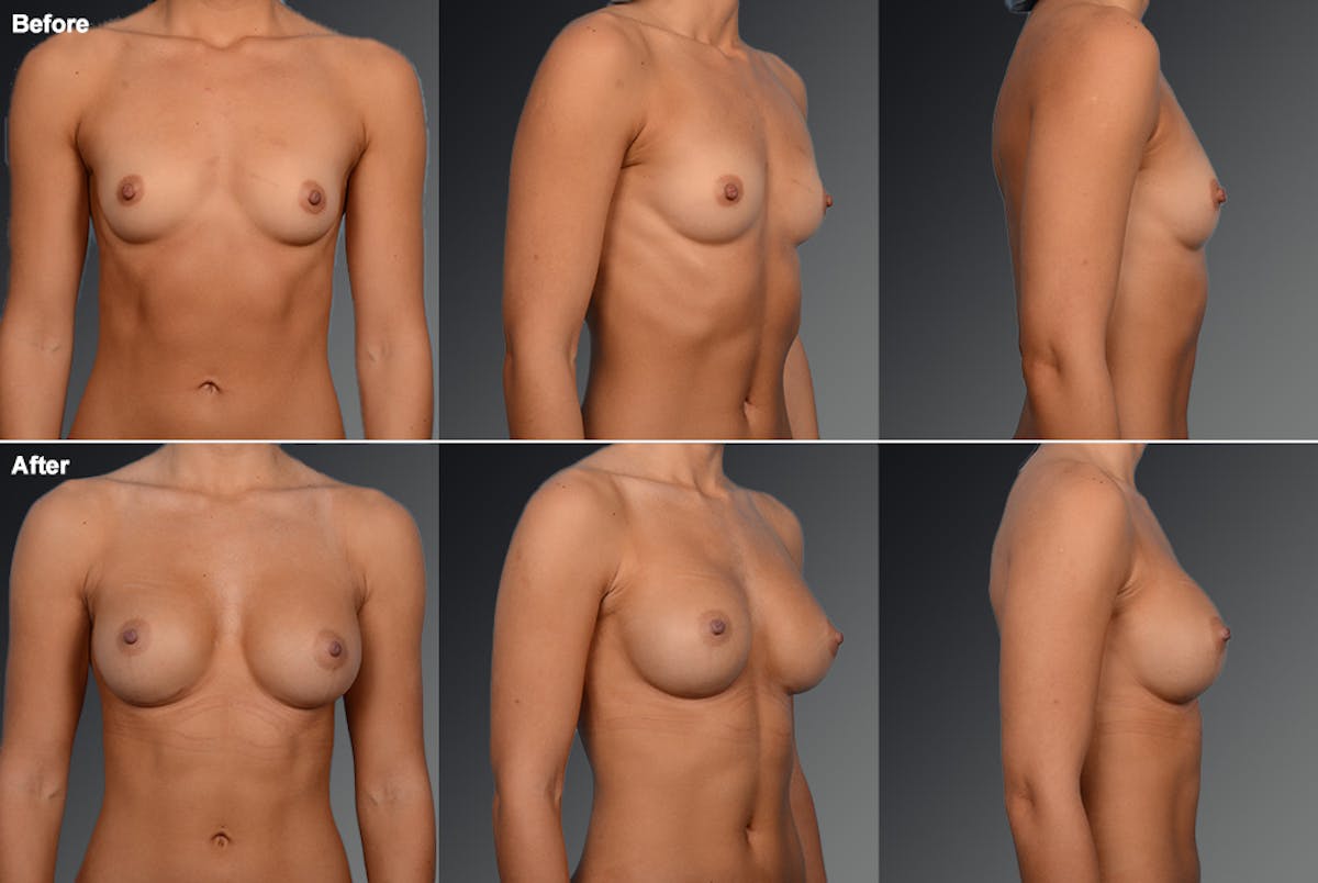 Breast Augmentation Before & After Gallery - Patient 104098355 - Image 1