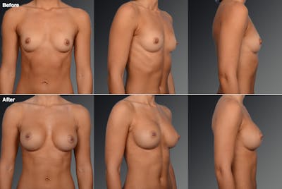 Breast Augmentation Before & After Gallery - Patient 104098355 - Image 1