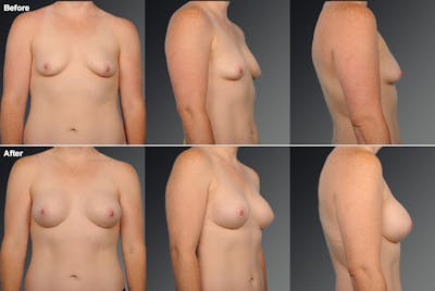 Breast Augmentation Before & After Gallery - Patient 104098363 - Image 1