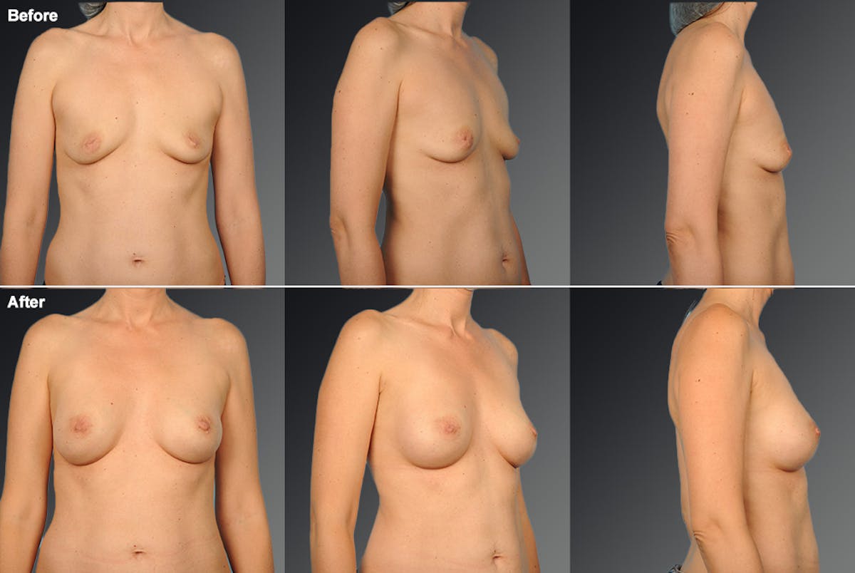 Breast Augmentation Before & After Gallery - Patient 104098368 - Image 1