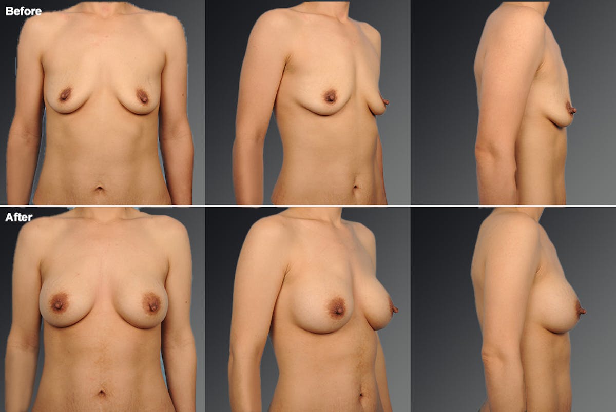 Breast Augmentation Before & After Gallery - Patient 104098369 - Image 1