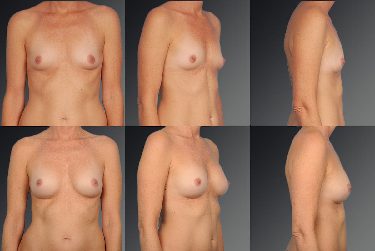 Breast Augmentation Before & After Gallery - Patient 104098370 - Image 1