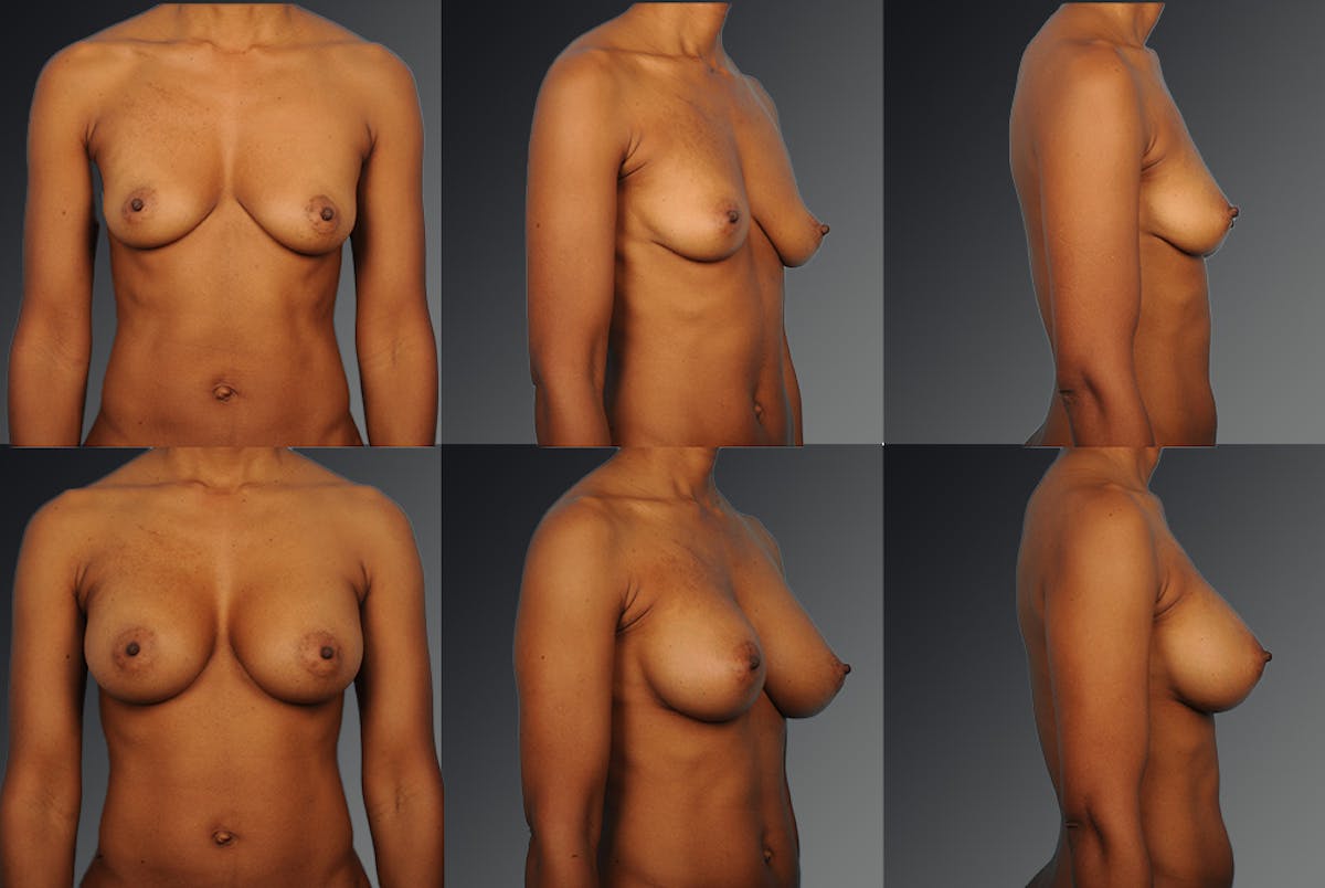 Breast Augmentation Before & After Gallery - Patient 104098376 - Image 1