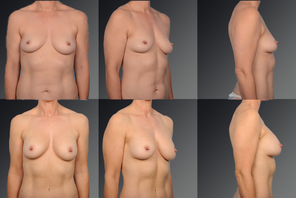Breast Augmentation Before & After Gallery - Patient 104098377 - Image 1
