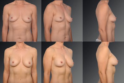 Breast Augmentation Before & After Gallery - Patient 104098377 - Image 1